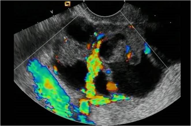 Ultrasound of ovarian cancer